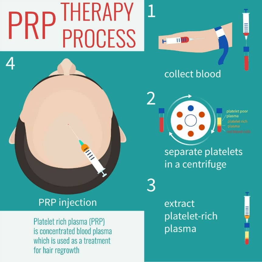 PRP therapy procedure for treating male pattern alopecia