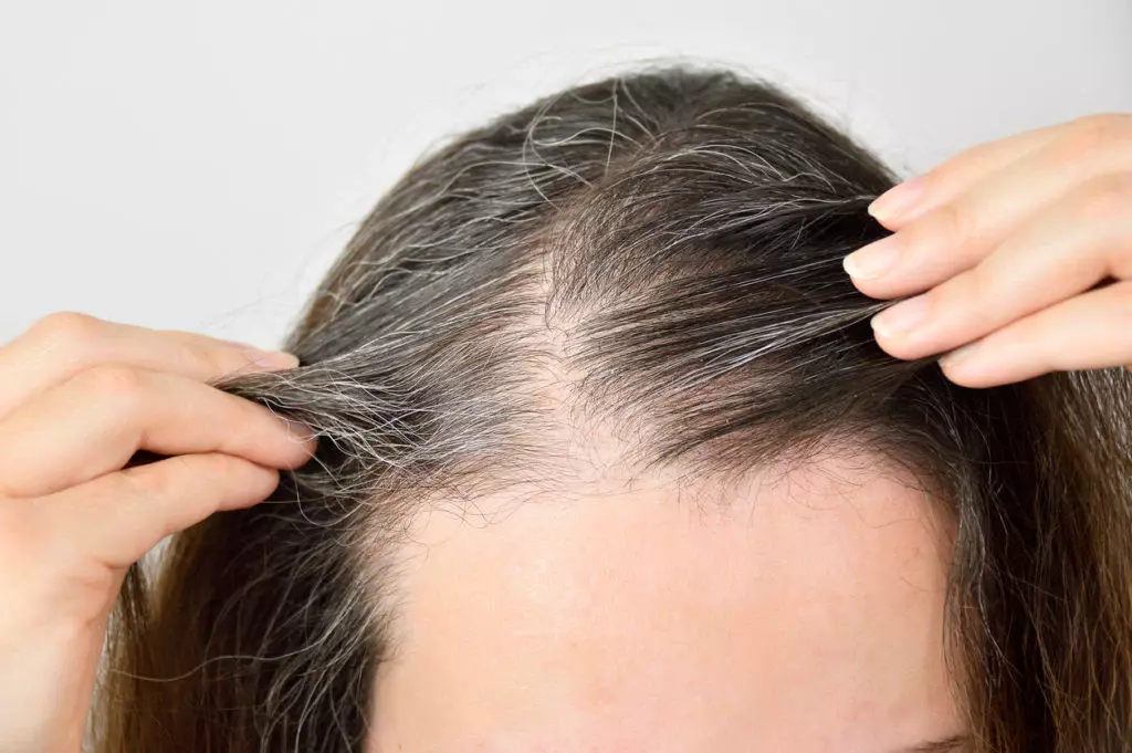 Telogen Effluvium