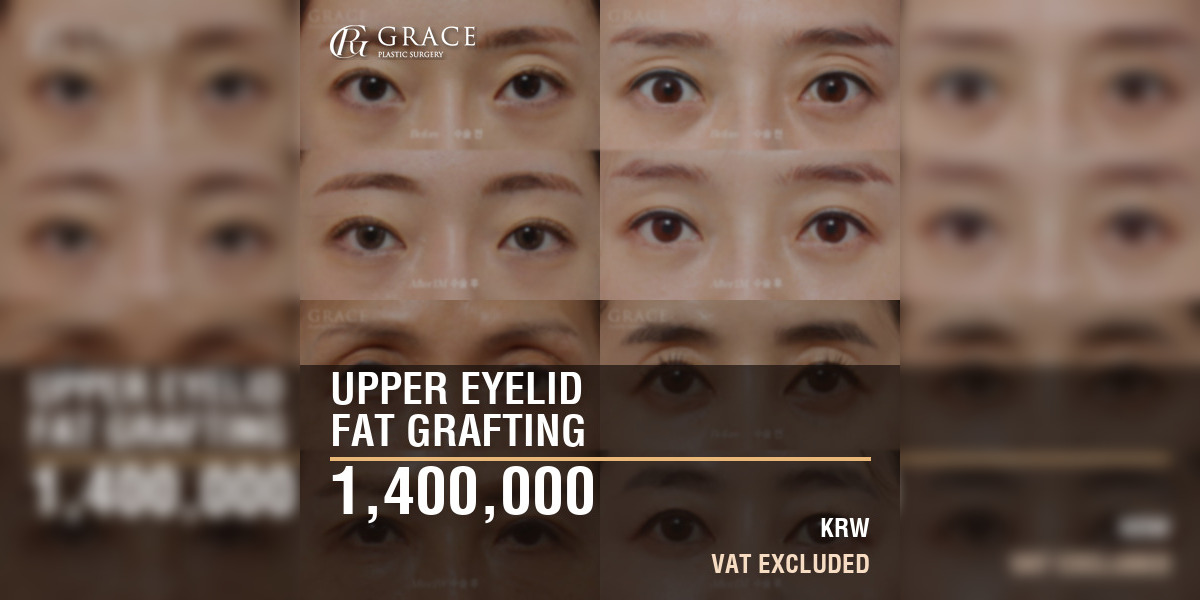Upper Eyelid Fat Grafting Cost in Korea: 1,400,000 KRW