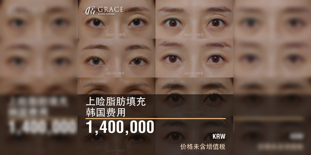 韩国上睑脂肪填充费用：1,400,000韩元