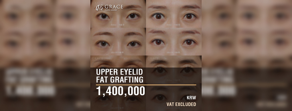 Upper Eyelid Fat Grafting Cost in Korea: 1,400,000 KRW