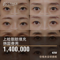 韩国上睑脂肪填充费用：1,400,000韩元