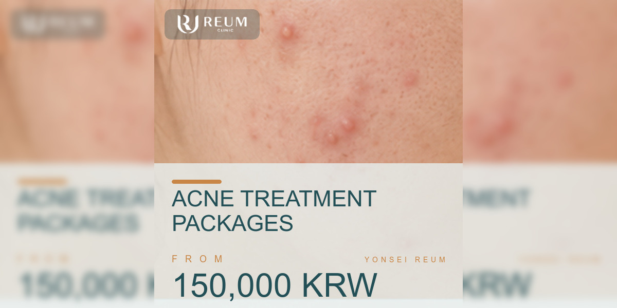 Acne Treatment Cost in Korea: 3 Packages from 150,000 KRW