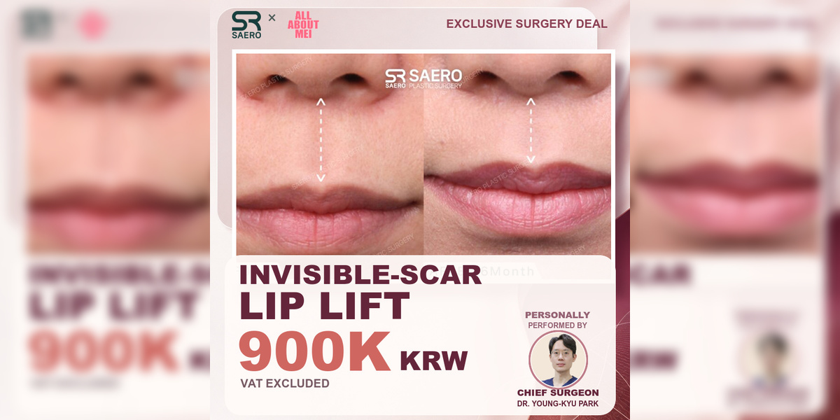 Invisible-Scar Lip Lift Cost: 900K KRW