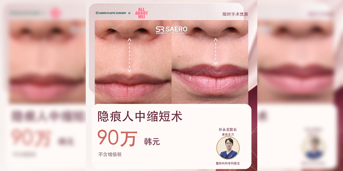 隐痕人中缩短术:90万韩元