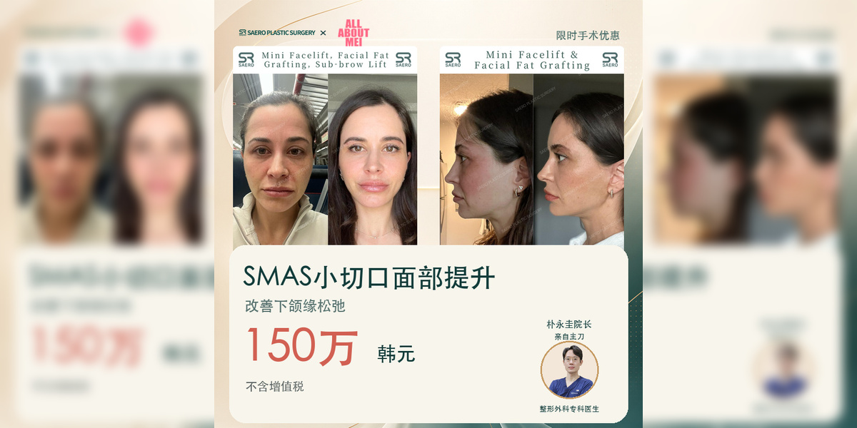 SMAS小切口面部提升：150万韩元，改善下颌缘松弛