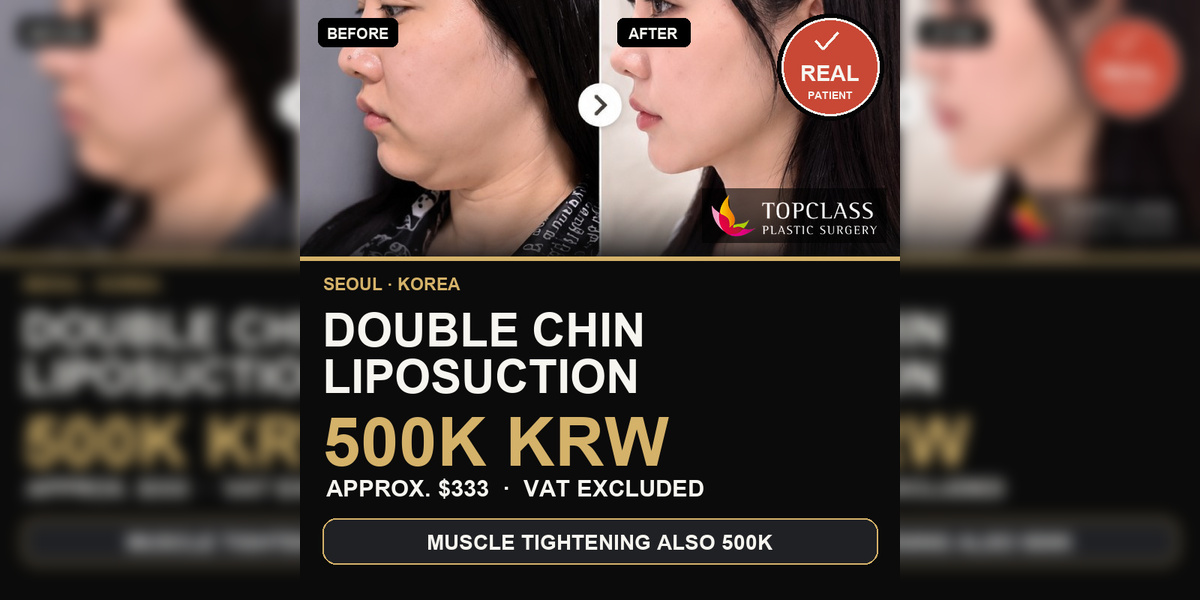 Double Chin Liposuction Cost in Korea: 500K KRW ($333)