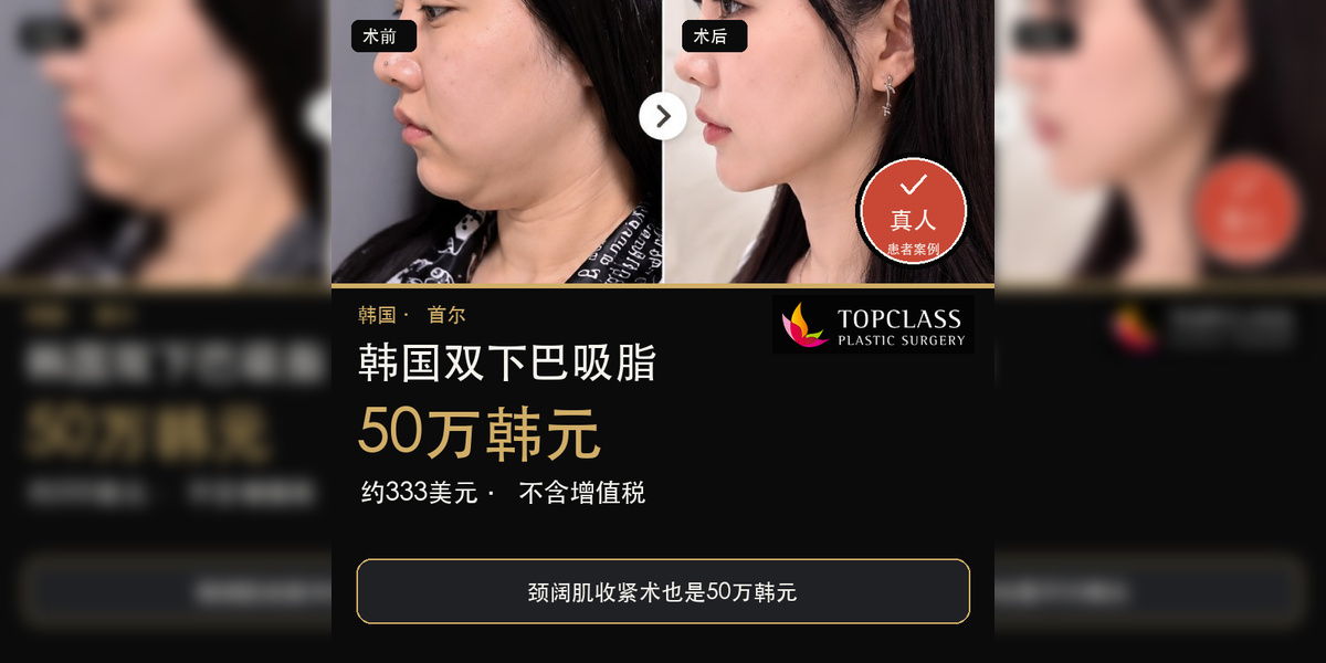 韩国双下巴吸脂价格：50万韩元（约333美元）
