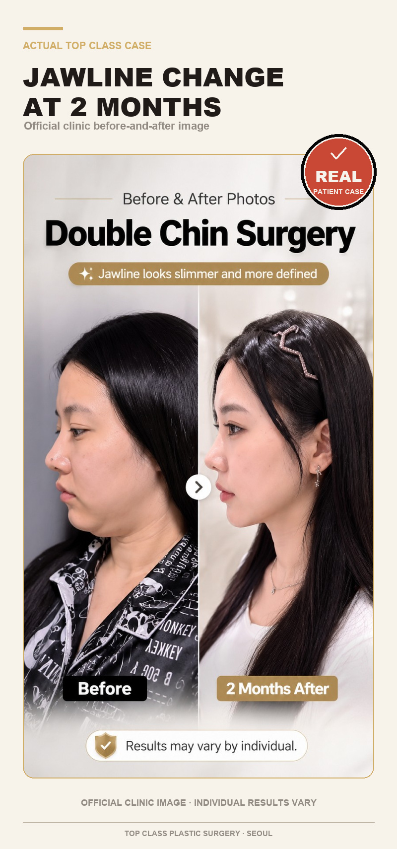 TOP CLASS官方双下巴案例 TOP CLASS官方双下巴手术术后2个月案例