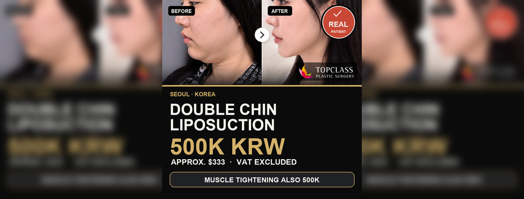 Double Chin Liposuction Cost in Korea: 500K KRW ($333)
