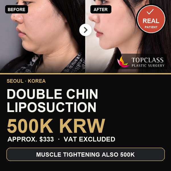 TOP CLASS double chin liposuction 500K KRW promotion thumbnail