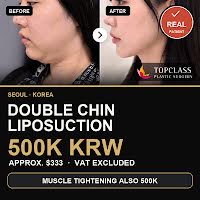 Double Chin Liposuction Cost in Korea: 500K KRW ($333)