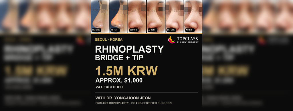 Rhinoplasty Cost in Korea: Bridge + Tip for 1.5M KRW ($1,000)