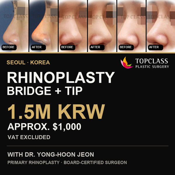 TOP CLASS bridge and tip rhinoplasty 1.5M KRW promotion thumbnail