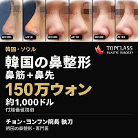 韓国の鼻整形：鼻筋＋鼻先 1,500,000ウォン（約1,000ドル）