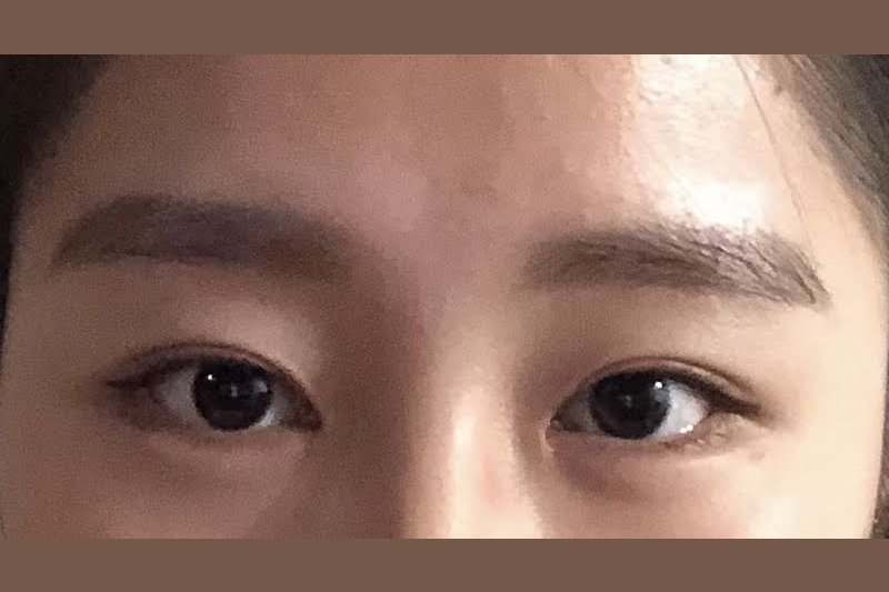 先做 5 秒捏折测试 适合评估双眼皮术式的较薄上眼睑