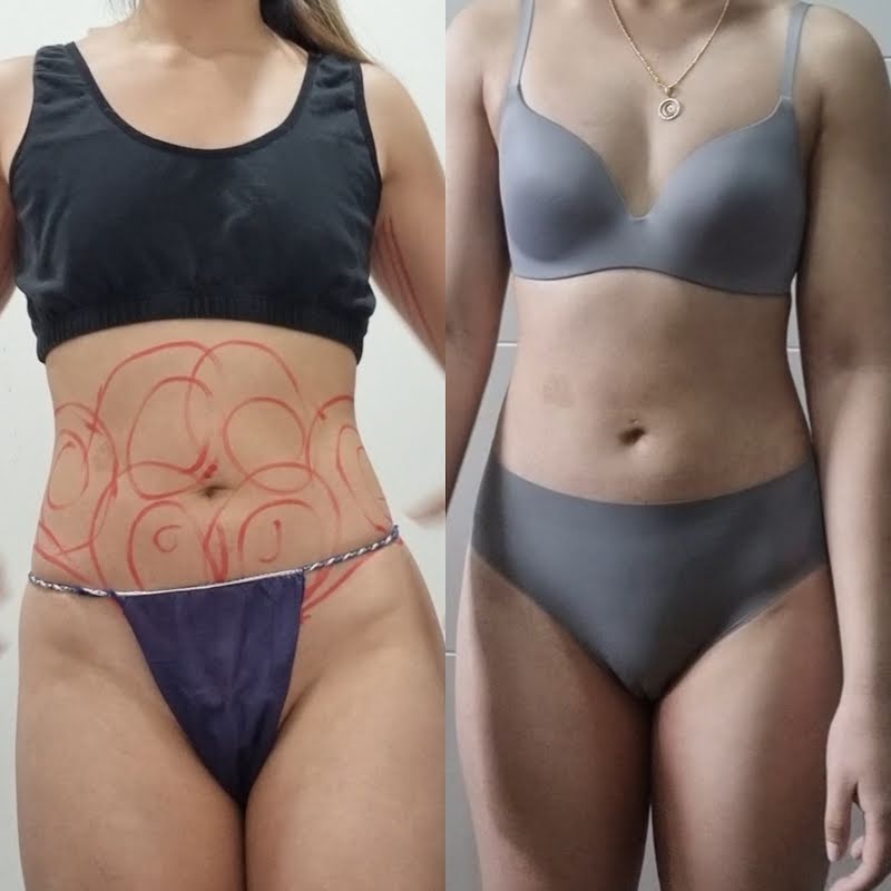 Arm and abdomen liposuction week 1 recovery Korea review