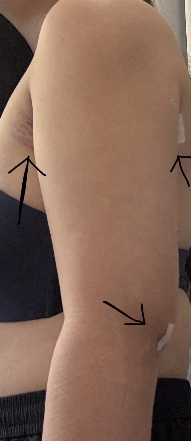 Arm liposuction TALKS review thumbnail