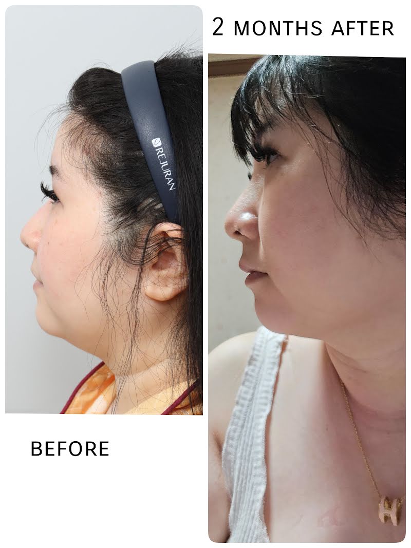 Jaw liposuction TALKS review thumbnail