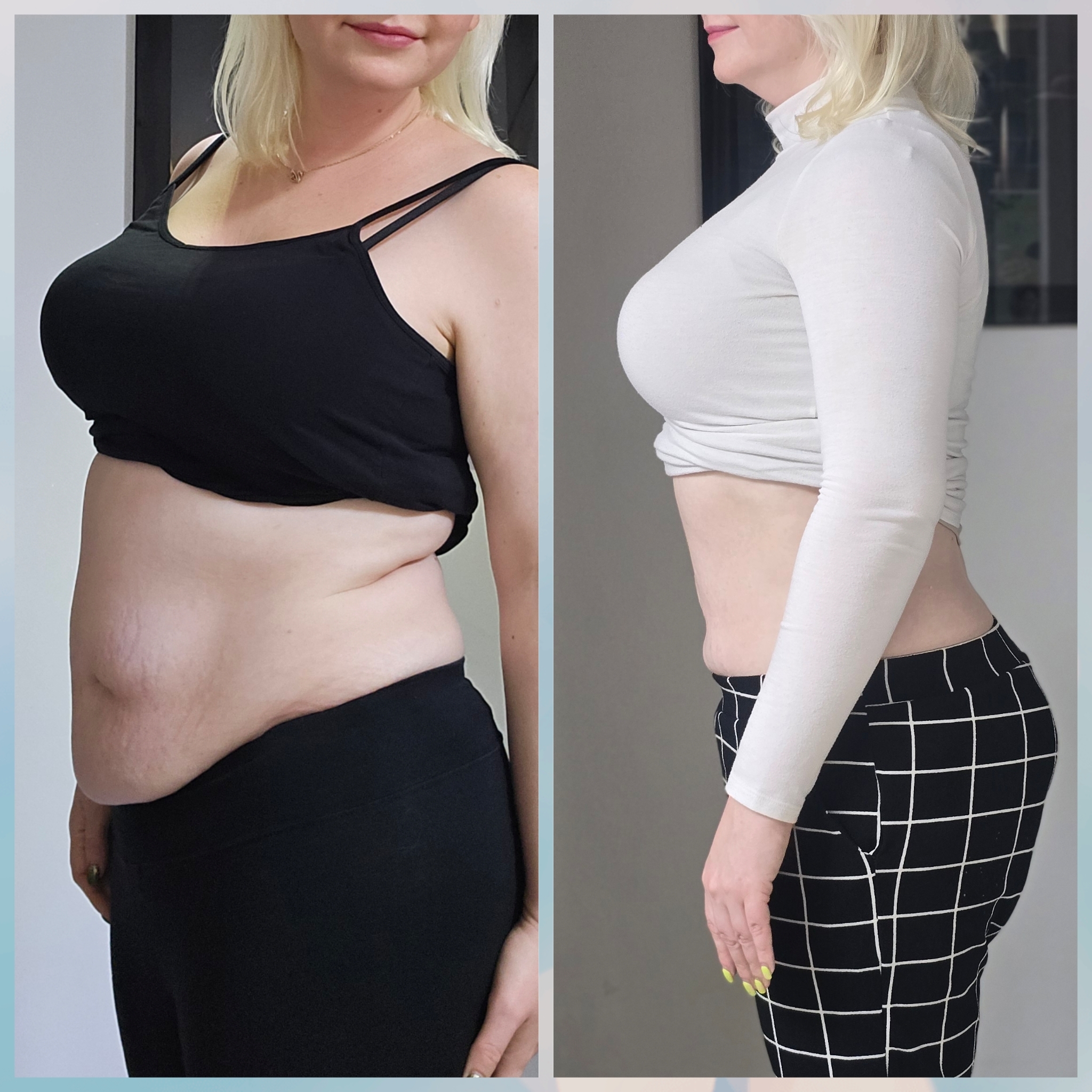 Abdomen liposuction TALKS review thumbnail