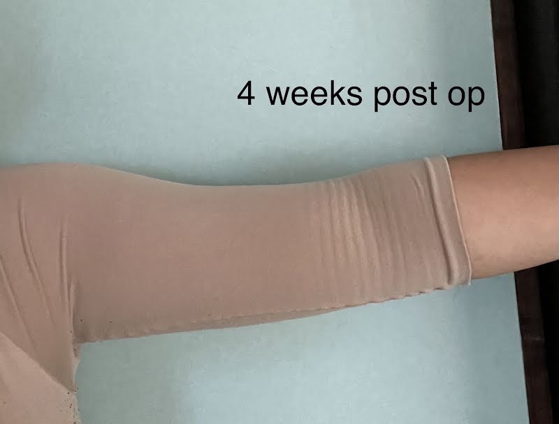 Ruby arm liposuction TALKS review thumbnail