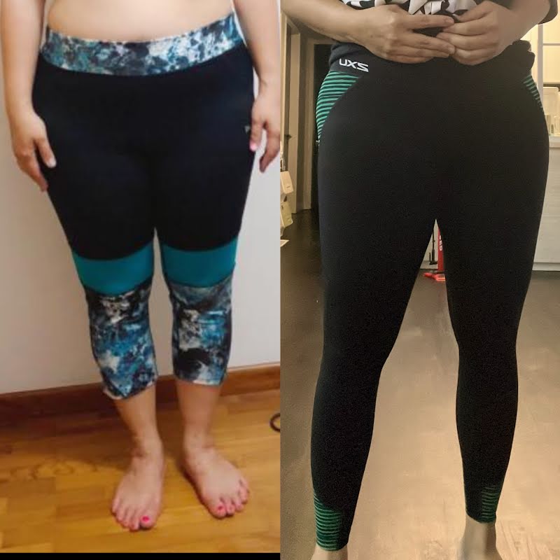 Thigh liposuction TALKS review thumbnail
