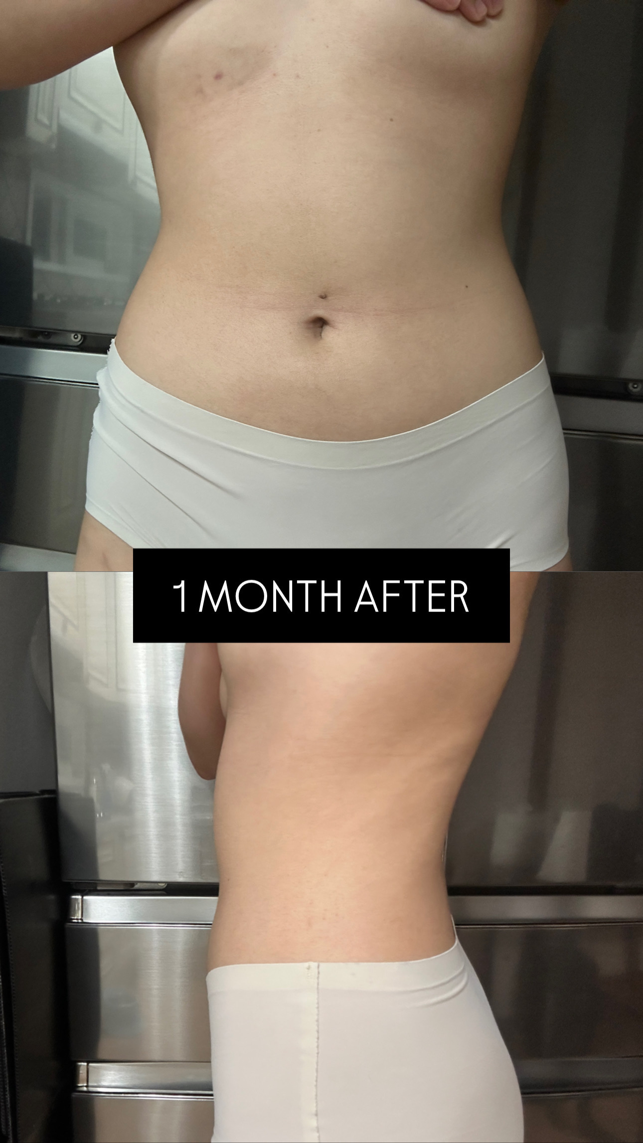 Triple One abdomen liposuction TALKS review thumbnail