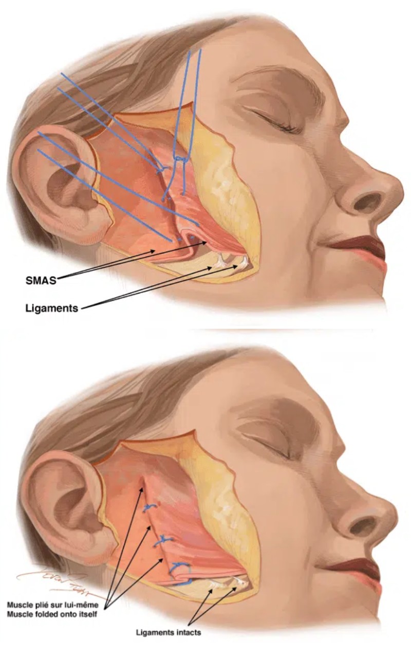 deep plane facelift explains in Korea