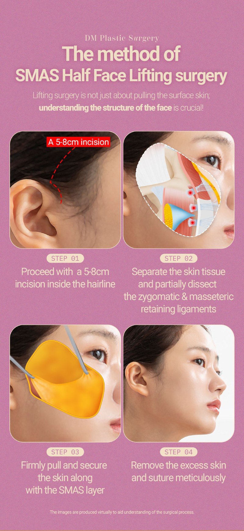 mid face facelift explains in Korea