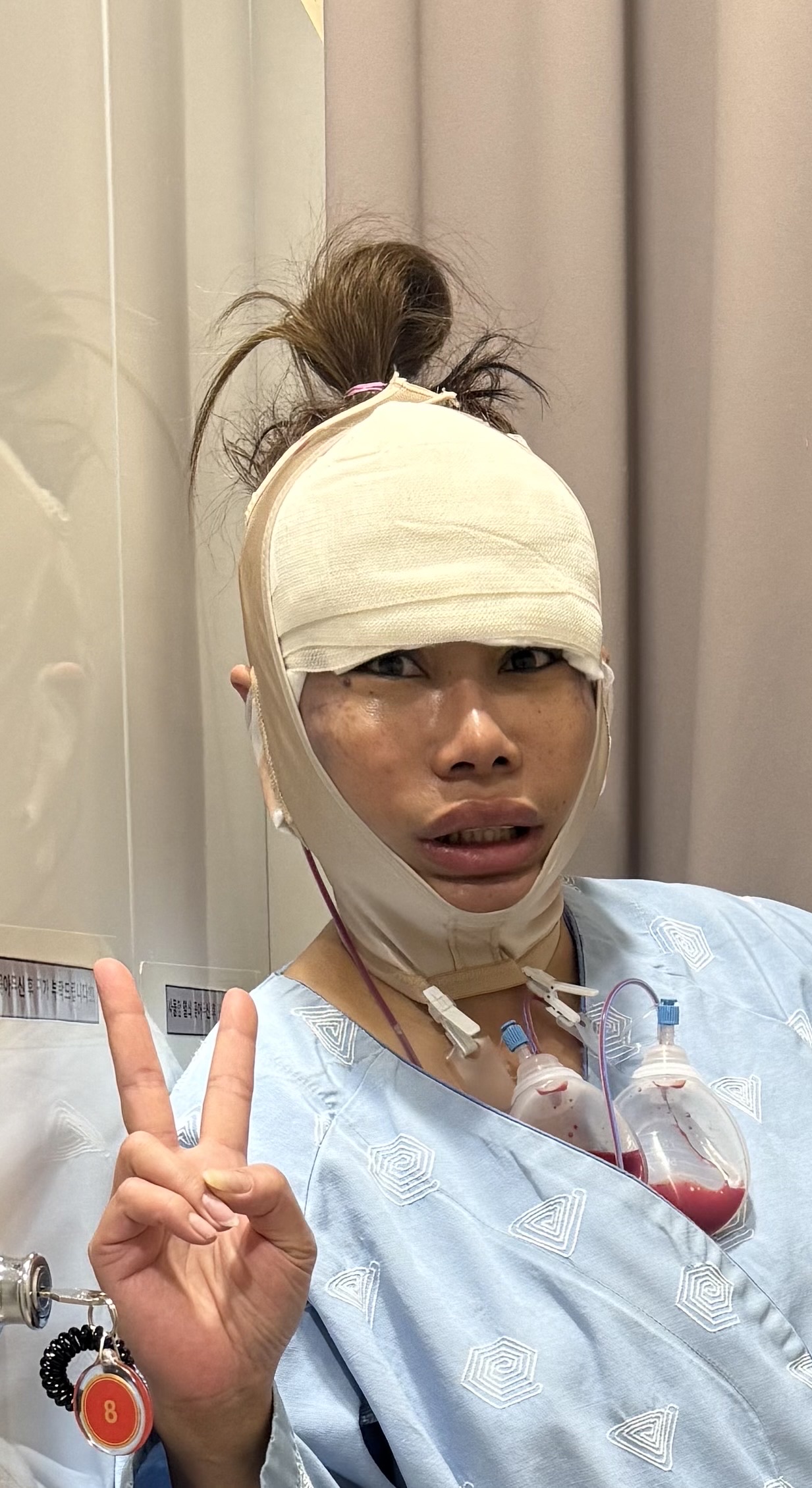 Liting L shaped incision facelift recovery review in Korea