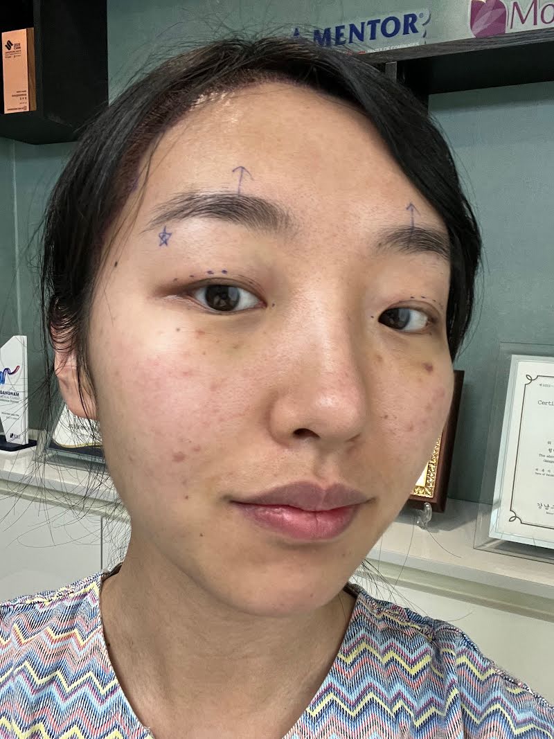 Double eyelid surgery consultation in Korea (before surgery) - recovery timeline