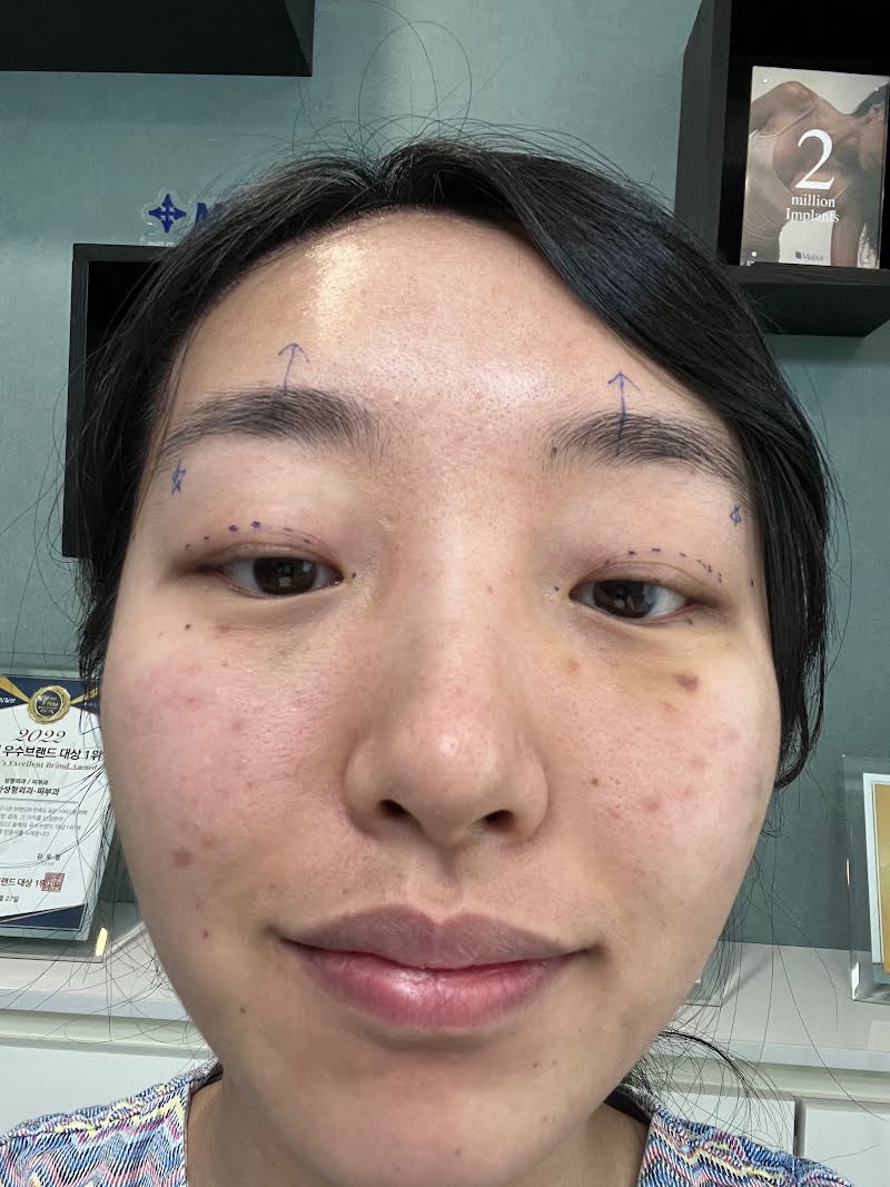 Before surgery consultation photo 2 - double eyelid surgery in Korea