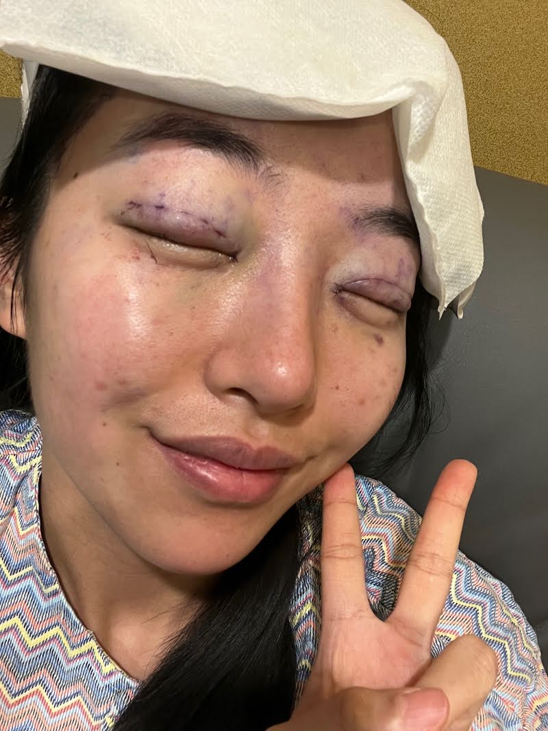 Day of double eyelid surgery in Korea - post-op photo (recovery timeline)