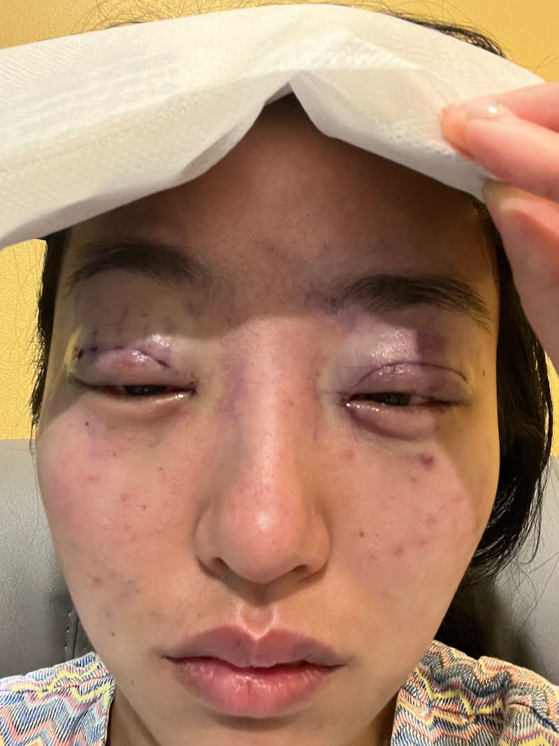 Day of surgery photo 2 - double eyelid surgery in Korea (post-op)