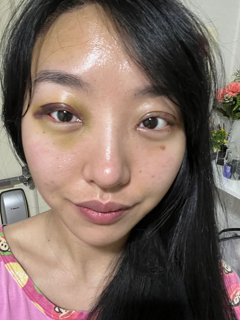Week 1 recovery photo 1 - double eyelid surgery in Korea (swelling)