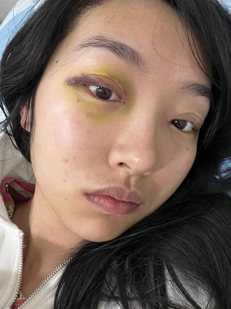 Week 1 recovery photo 2 - double eyelid surgery in Korea (swelling)