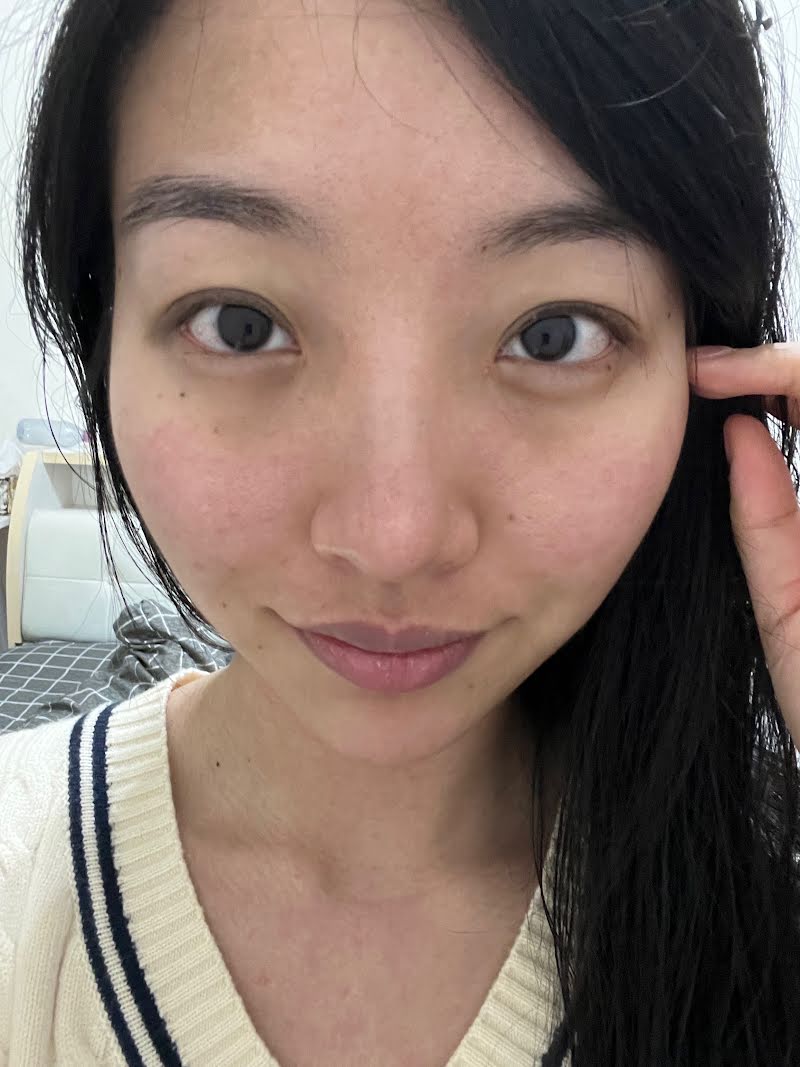 Double eyelid surgery recovery in Korea - 3 weeks after surgery