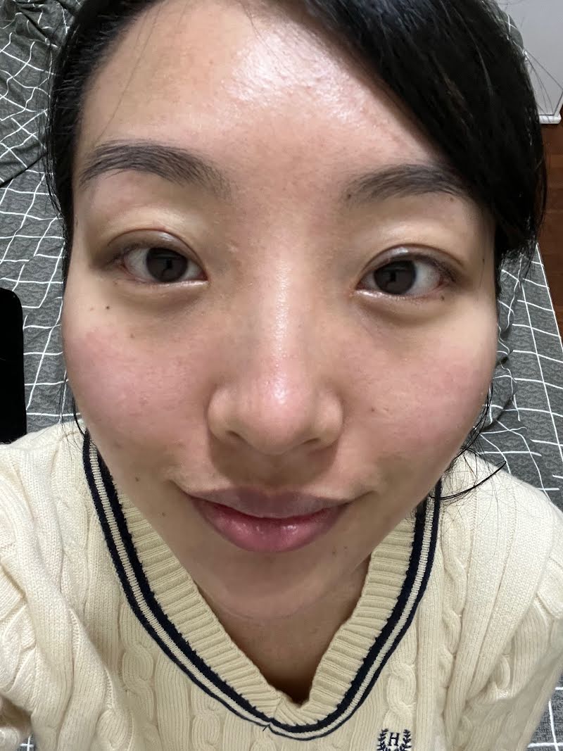 Week 3 recovery photo 2 - double eyelid surgery in Korea (natural look)