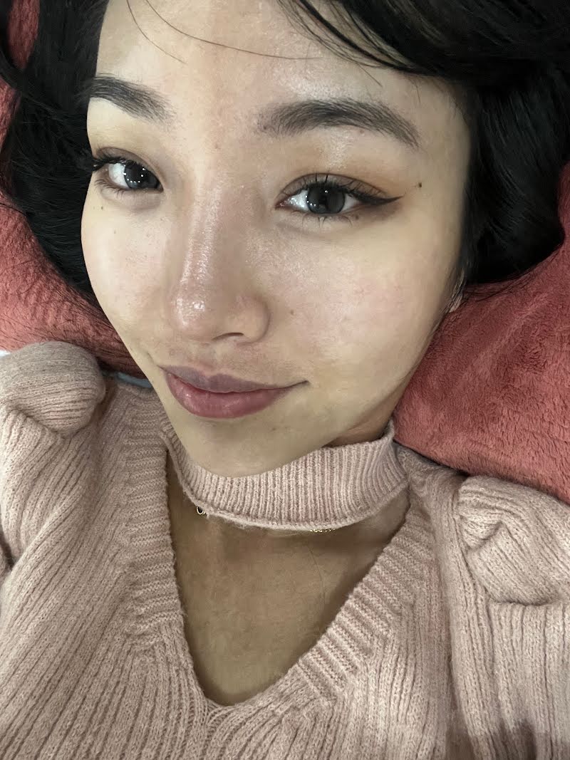 Month 2.5 recovery photo - double eyelid surgery in Korea (healed, natural)