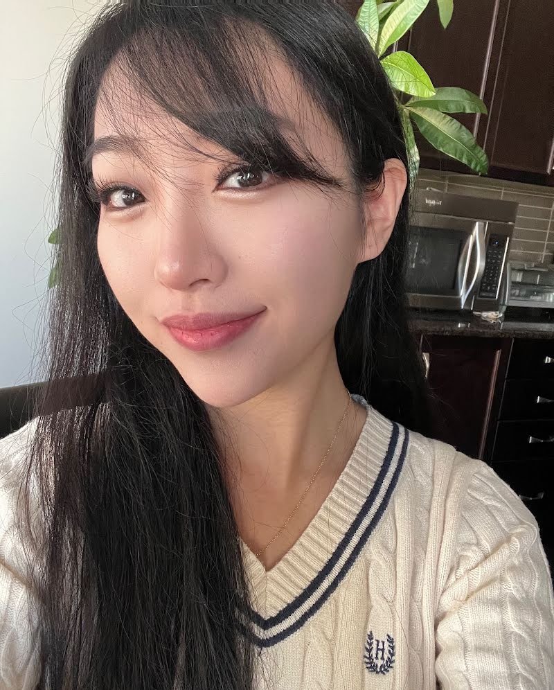 Month 5 recovery photo - double eyelid surgery in Korea (settled results)