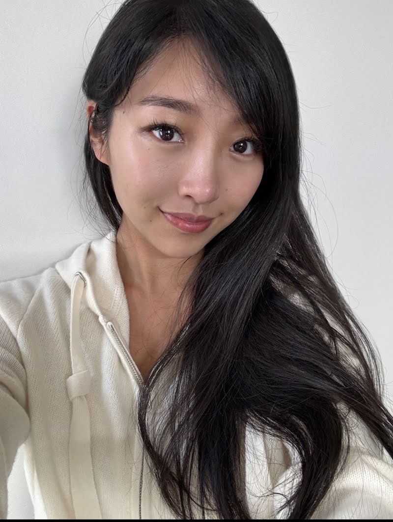 Month 10 recovery photo 1 - double eyelid surgery in Korea (final natural results)