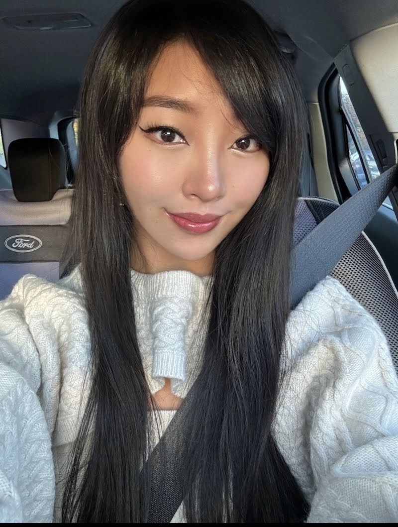 Month 10 recovery photo 2 - double eyelid surgery in Korea (final natural results)