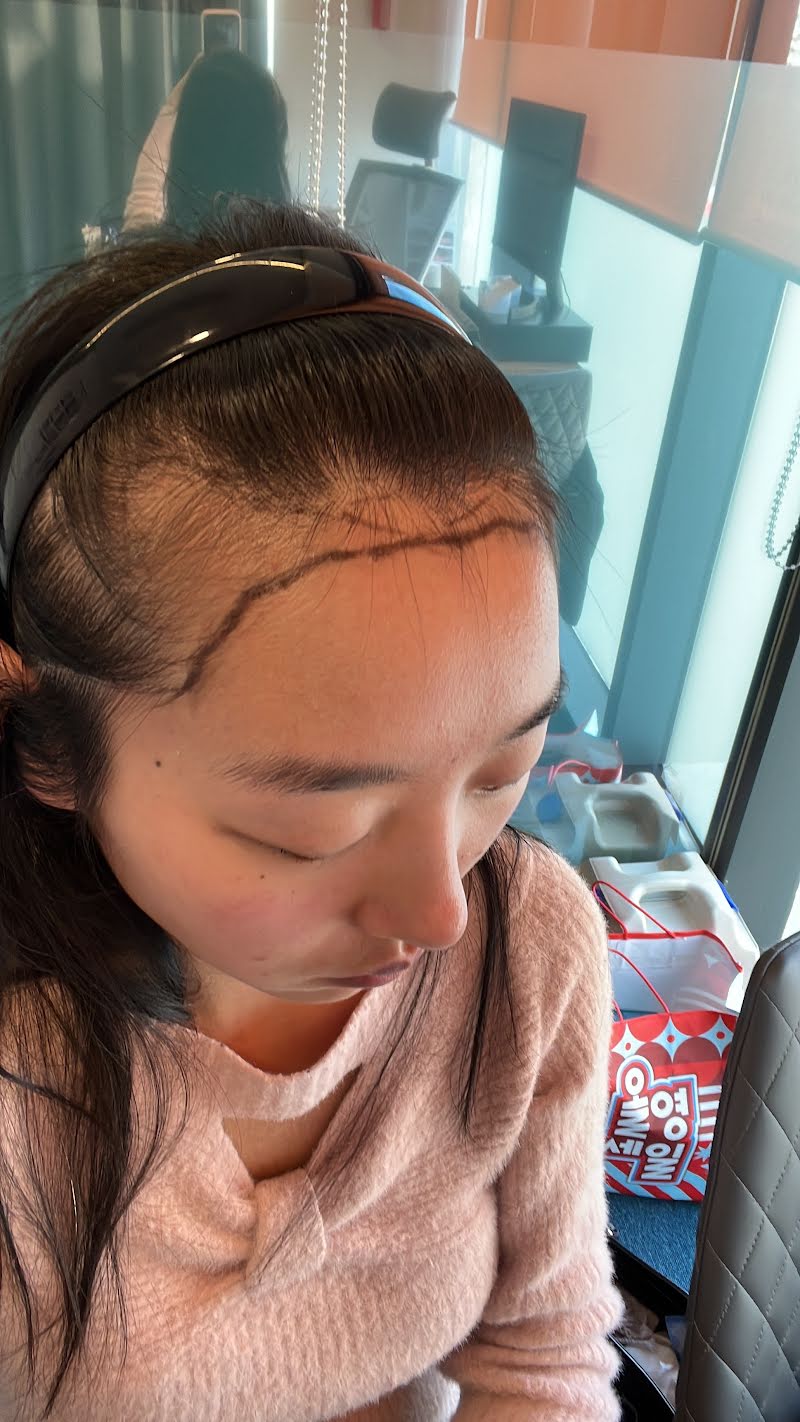 Hairline transplant consultation in Korea - clinic visit photo