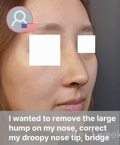 Amy advanced rhinoplasty review at RUBY Plastic Surgery with hump removal bridge augmentation and droopy tip correction