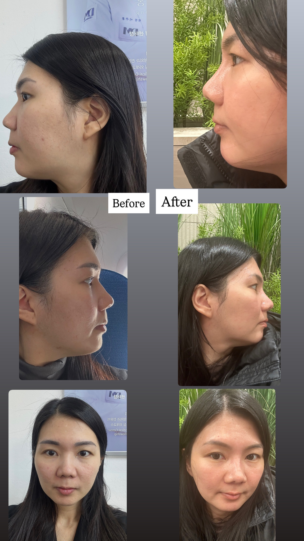 11 months post op with Dr Lee Joo Hong at DM Plastic Surgery thumbnail