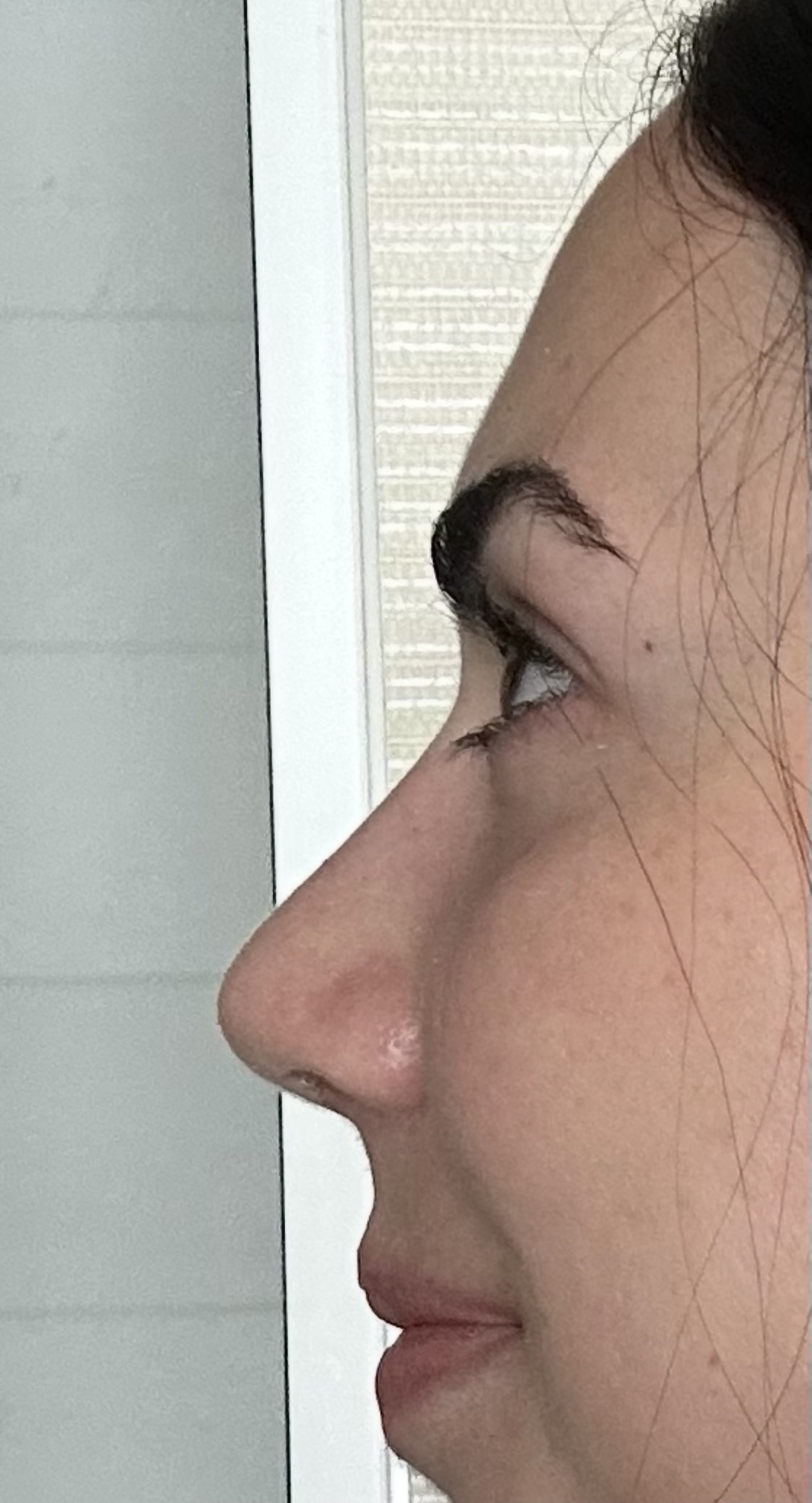 1 month after rhinoplasty at ASPS thumbnail