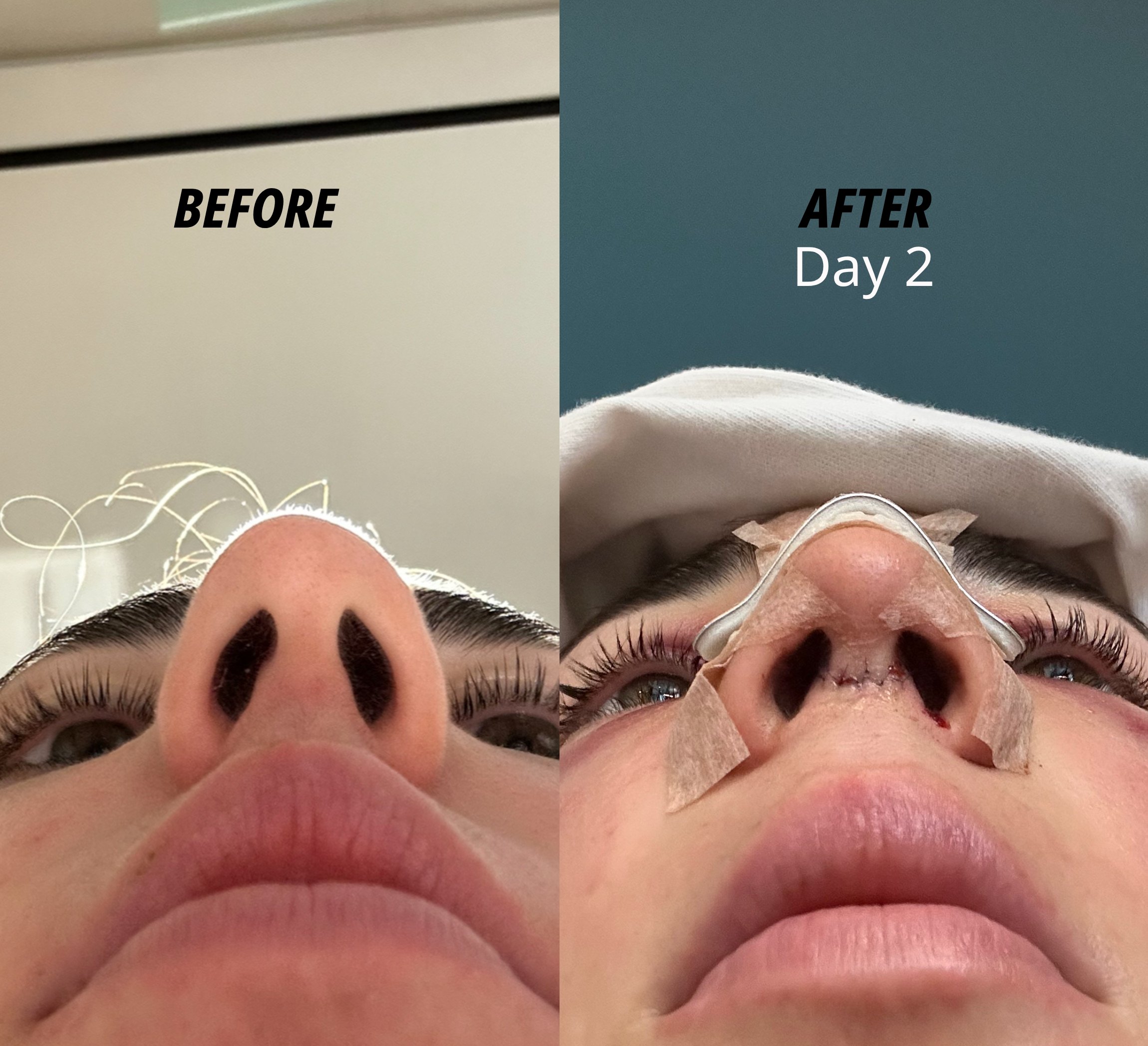My rhinoplasty journey in ASPS thumbnail