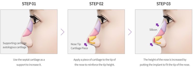 4 types of implant materials for rhinoplasty research thumbnail