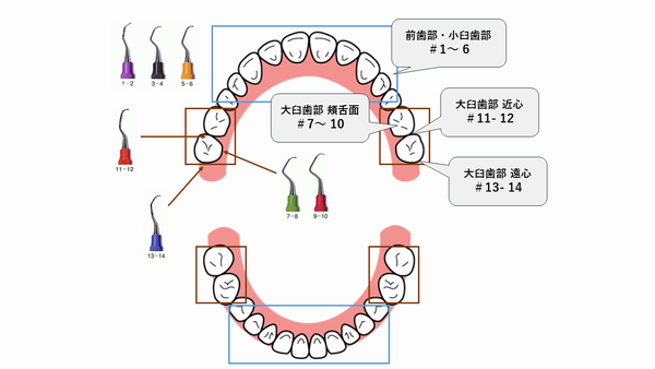 スノーブルー Hu-Friedy グレーシーキュレットスケーラー（両頭）10本