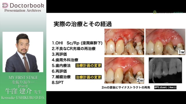 根分岐